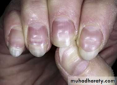 NailDiseases