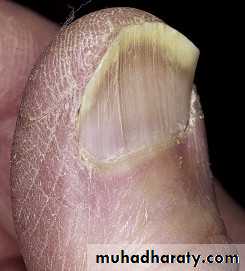 NailDiseases
