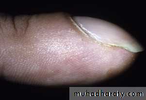 NailDiseases