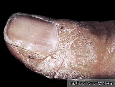 NailDiseases