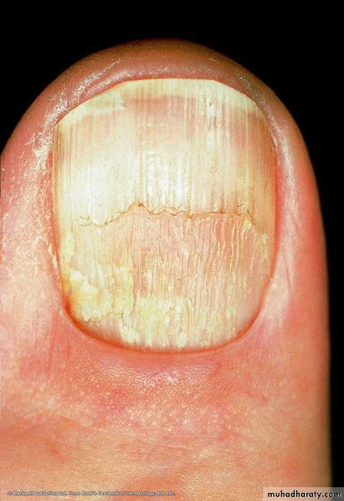 NailDiseases