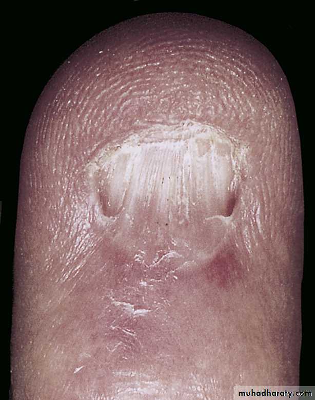 NailDiseases