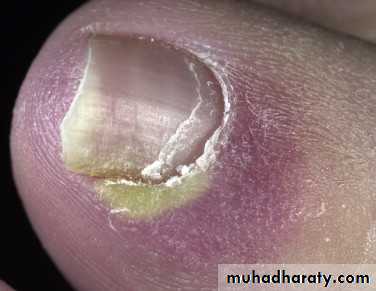 NailDiseases