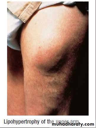 Diabetes Mellitus