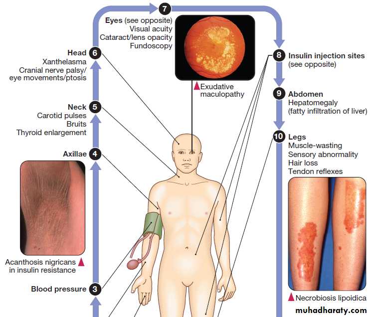 Diabetes Mellitus