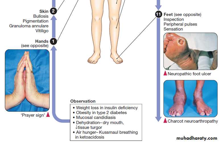 Diabetes Mellitus