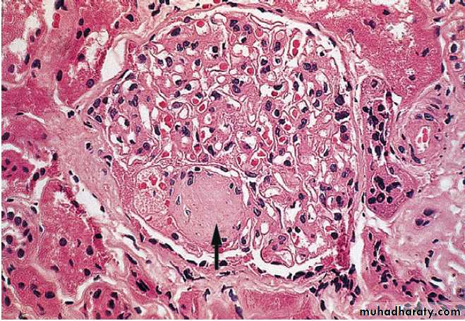 Diabetes Mellitus