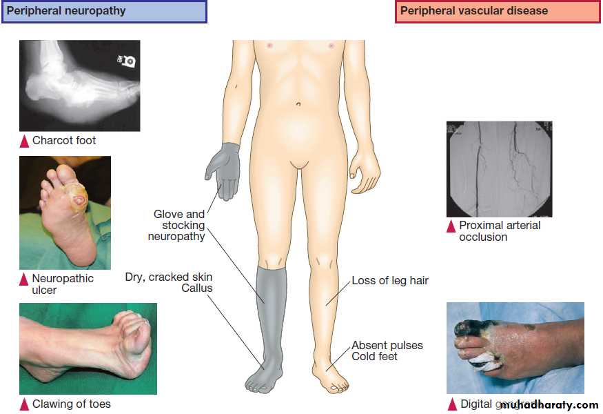 Diabetes Mellitus