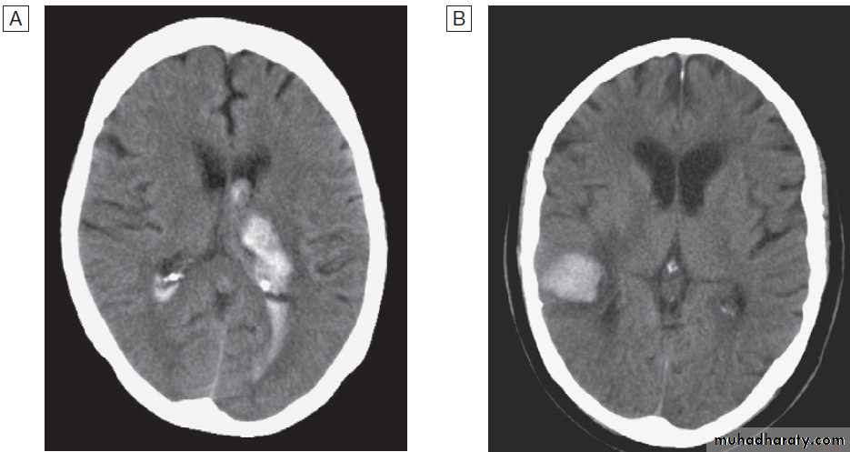 Stroke