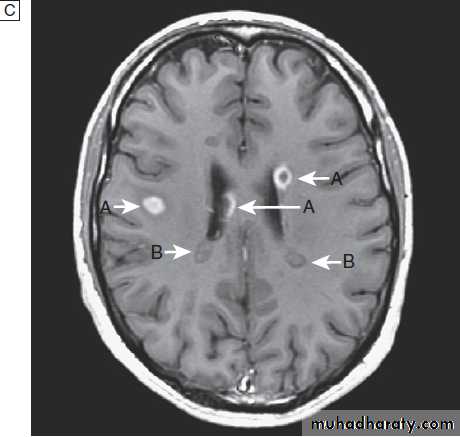 Neurological disease