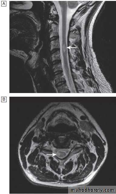 Neurological disease