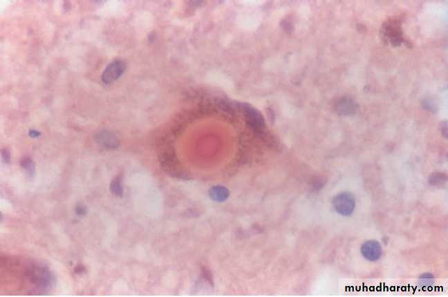 Neurological disease