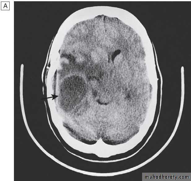 Neurological disease