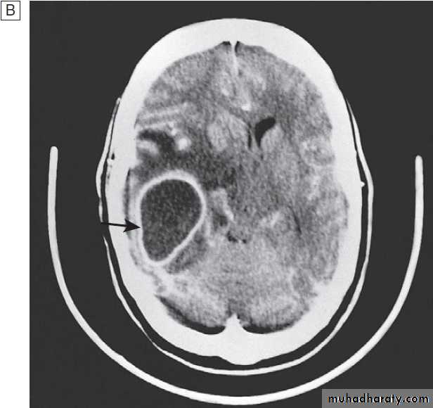 Neurological disease