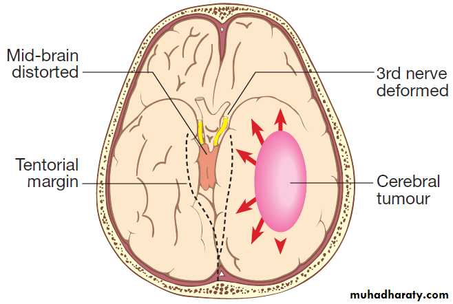 Neurological disease