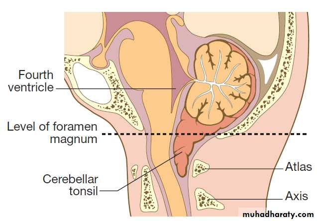 Neurological disease