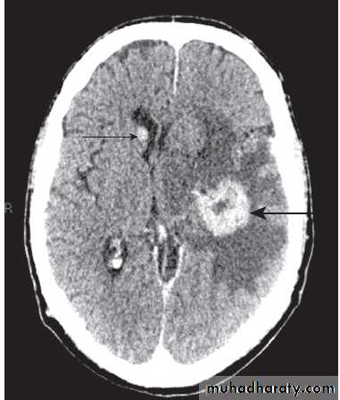Neurological disease