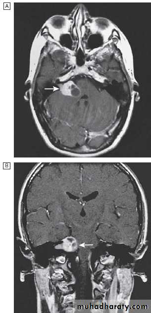 Neurological disease