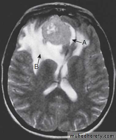 Neurological disease