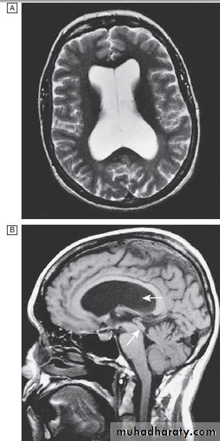 Neurological disease