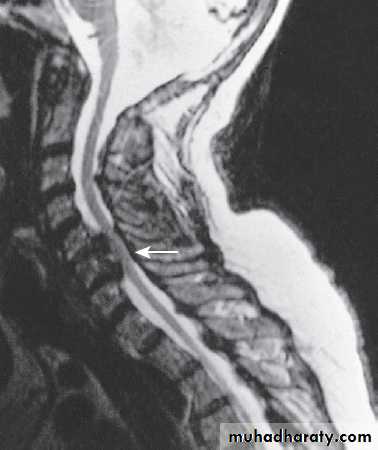 Neurological disease