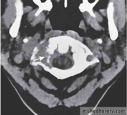 Neurological disease