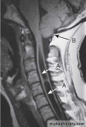 Neurological disease