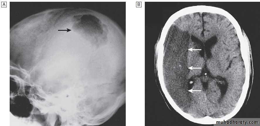 Neurological disease