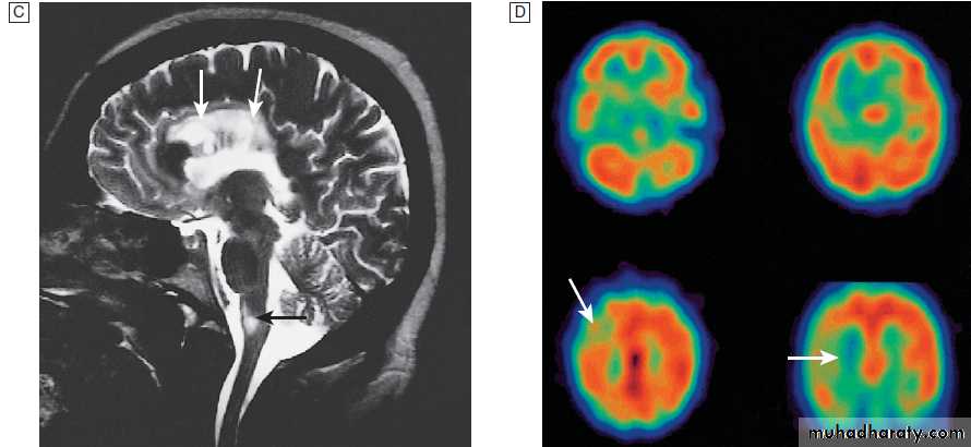 Neurological disease
