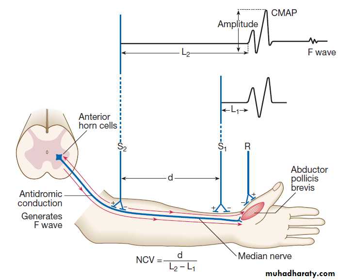 Neurological disease
