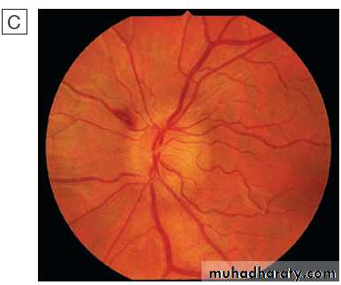 Neurological disease