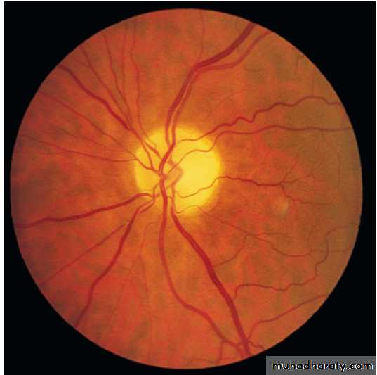 Neurological disease