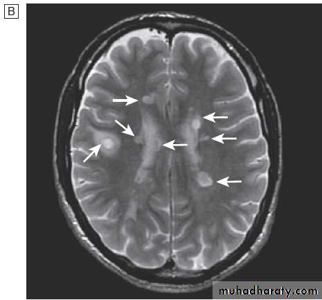 Neurological disease
