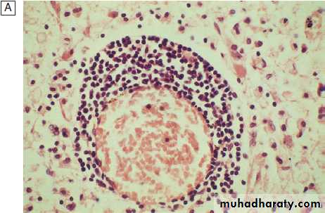 Neurological disease