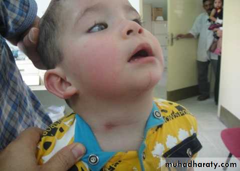 pediatric-surgery-3-neck-mass