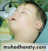 pediatric-surgery-3-neck-mass