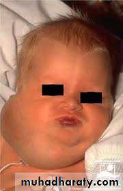pediatric-surgery-3-neck-mass