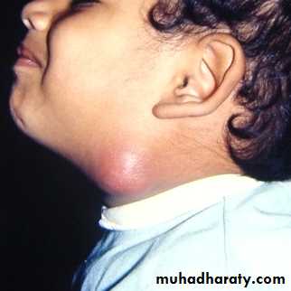 pediatric-surgery-3-neck-mass