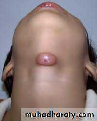 pediatric-surgery-3-neck-mass