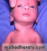 pediatric-surgery-3-neck-mass