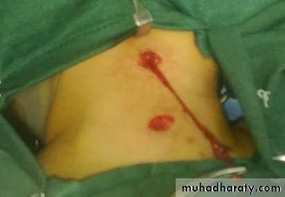 pediatric-surgery-3-neck-mass