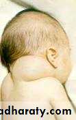 pediatric-surgery-3-neck-mass