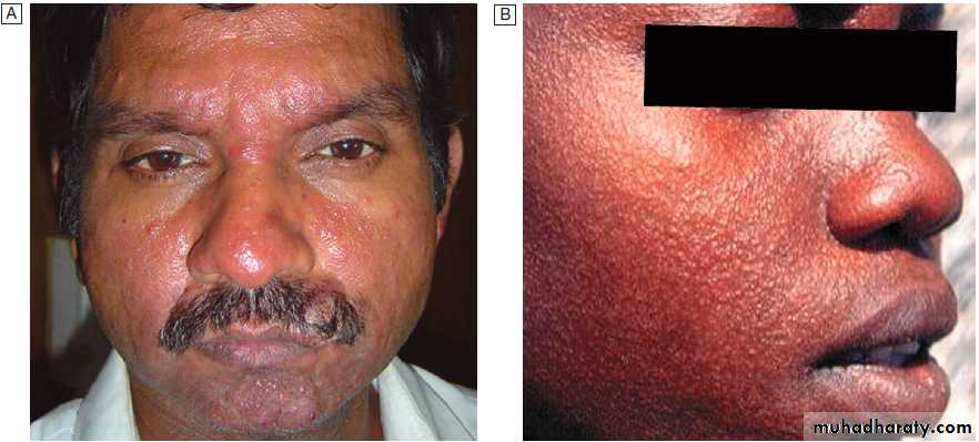 Infectious disease