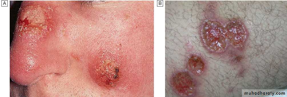 Infectious disease