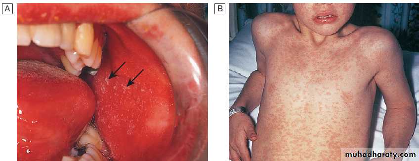 Infectious disease