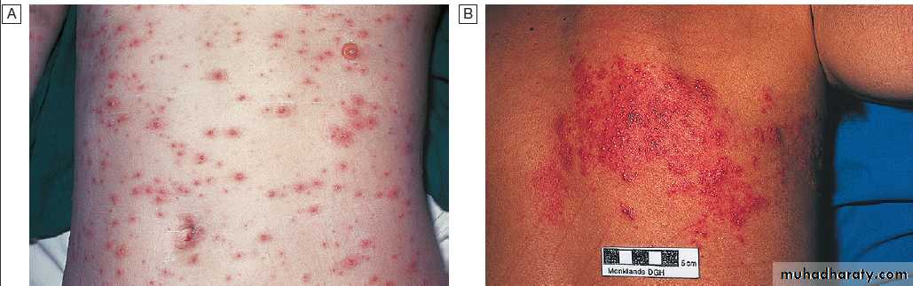 Infectious disease