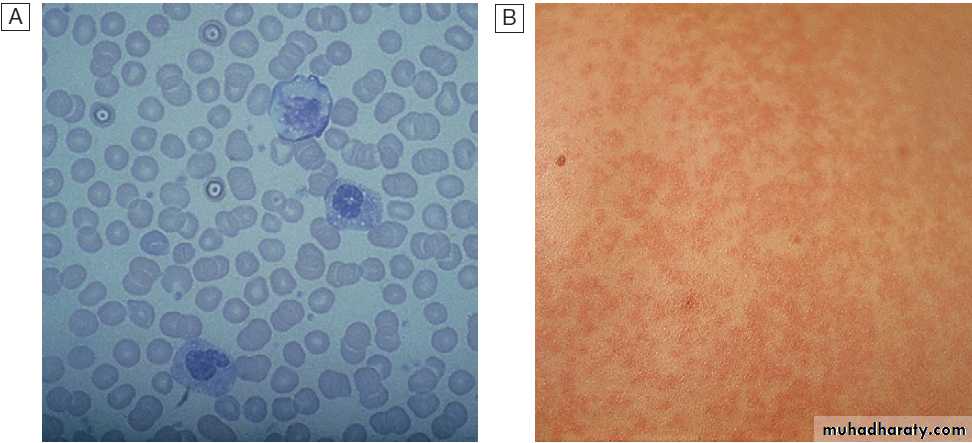 Infectious disease