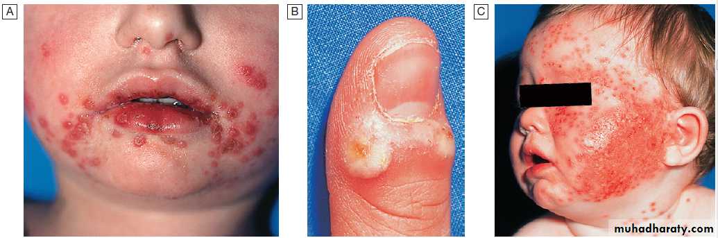 Infectious disease