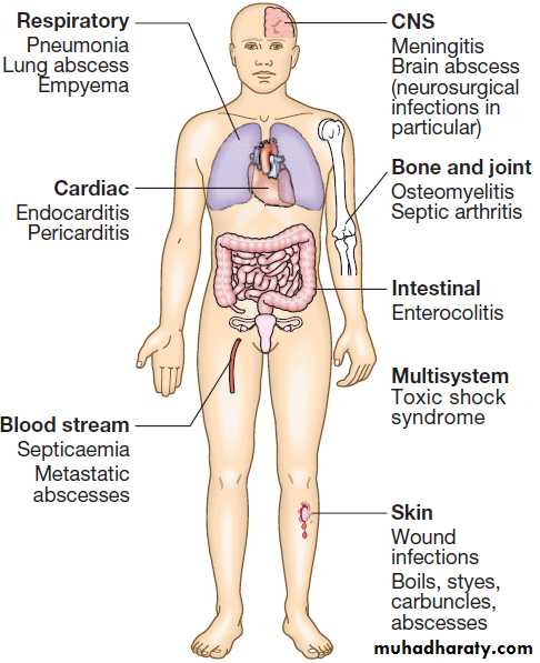 Infectious disease