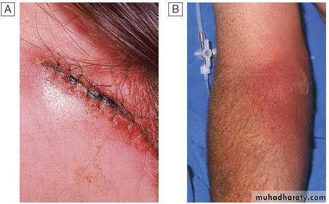 Infectious disease